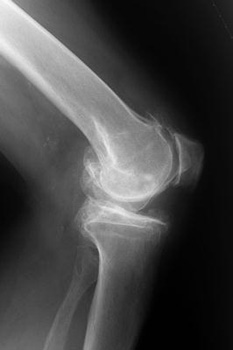Radiografa de rodilla