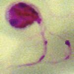 Plasmodium falciparum, causante del paludismo