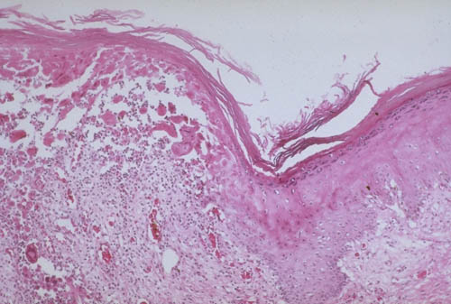 La epidermis de la piel contiene alfa-queratinas. Imagen de http://medlib.med.utah.edu/kw/derm/mml/24850016.jpg