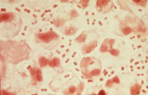 Neisseria gonorrhoeae, bacteria de la Gonorrea