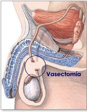 Vasectoma