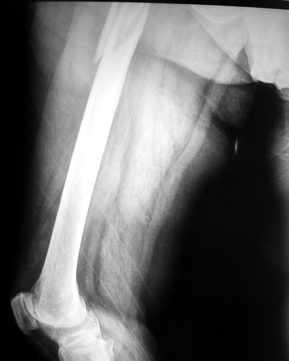 Radiografa de fractura de femur