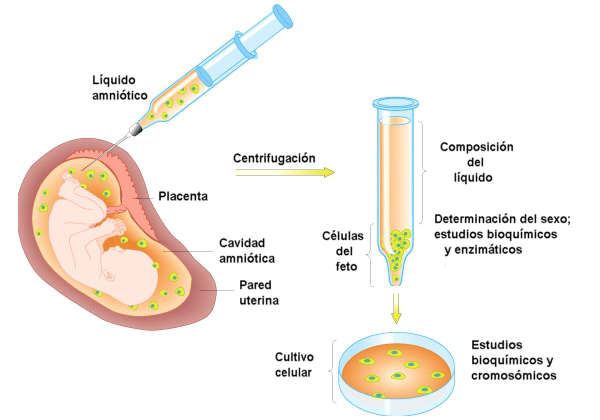 La amniocentesis permite detectar gran nmero de anomalas genticas, ya que analiza directamente los cromosomas del feto. Adaptada de fig.cox.miami.edu